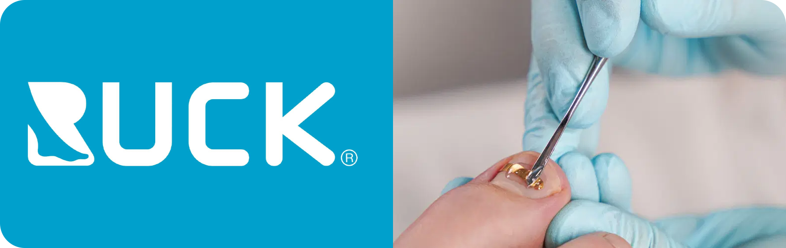 RUCK | תיקון ציפורניים ואורטונקסיה – פתרונות מקצועיים לפודולוגיה