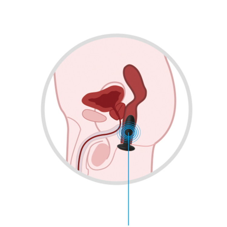 Bess - פלאג אנאלי